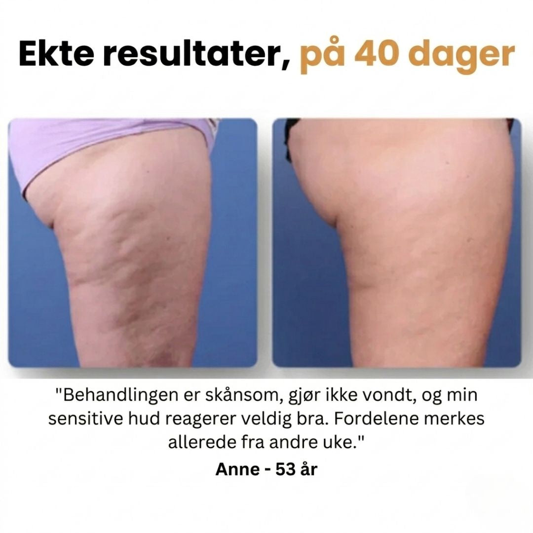 Mure Anti-cellulitt massasjeapparat