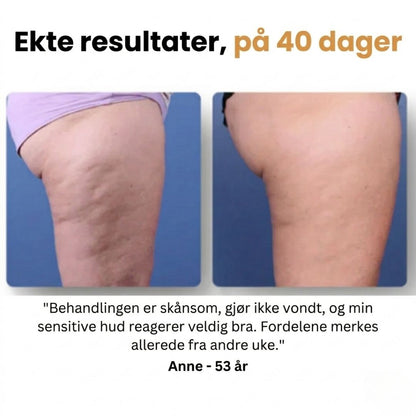 Mure Anti-cellulitt massasjeapparat